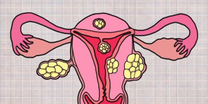 女性患有子宫肌瘤会影响怀孕吗?
