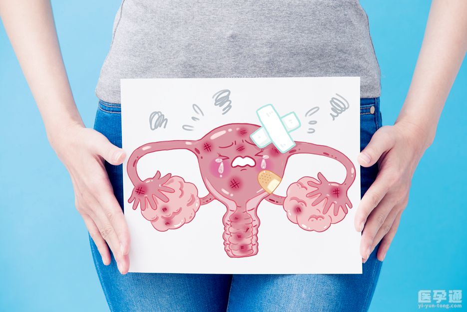 多囊卵巢可以直接做试管婴儿吗？可以，赠你多囊卵巢综合征试管注意事项 (1).jpg
