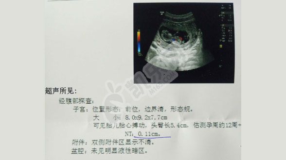 孕期12周检查nt值1.3mm是男是女（附网友真是案例）(图2)