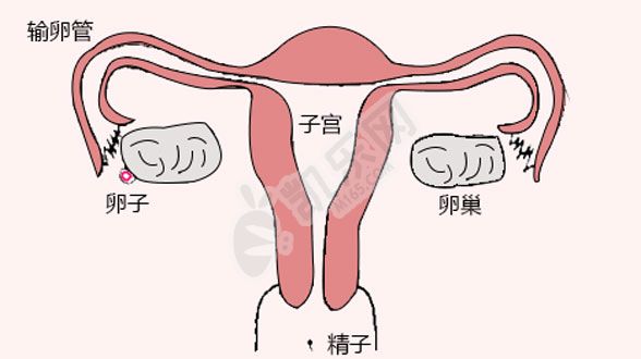 输卵管堵塞是复通还是试管婴儿好？(图3)