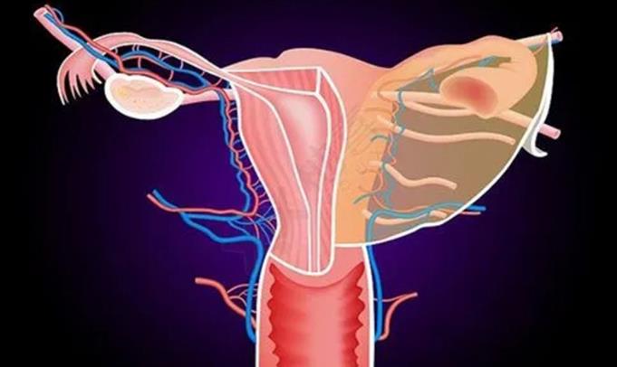 子宫腺肌症最怕三种运动是哪些？子宫腺肌症要如何治疗？