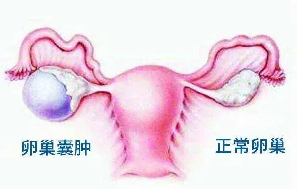 南京卵巢囊肿能不能做试管？需要供卵试管吗？