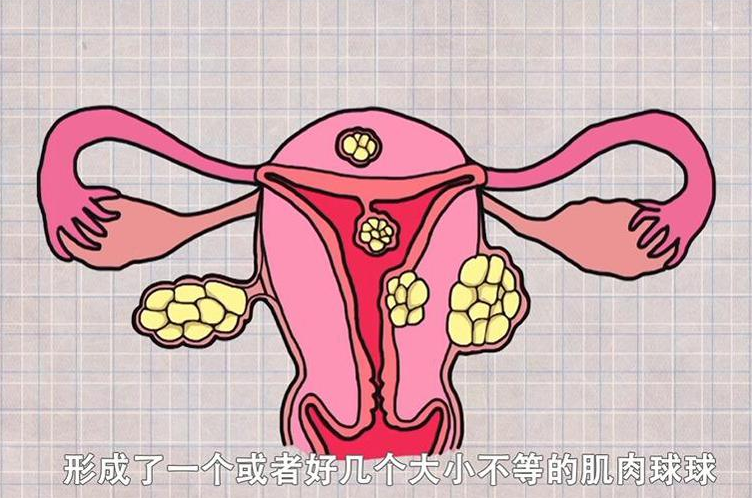 女性患有子宫肌瘤会影响怀孕吗?