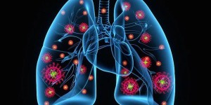 肺脓肿是什么病？严重吗？一文给你解答