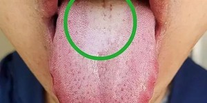 舌苔黄厚腻是什么原因造成的？大多是这五个因素在作怪