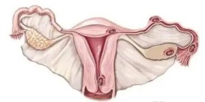 有子宫腺肌症做试管女成功率高吗？