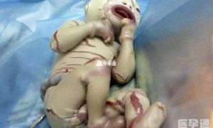 火棉胶婴儿是什么症状？通过图片告诉你有多可怜！