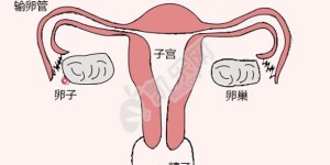 输卵管堵塞是复通还是试管婴儿好？