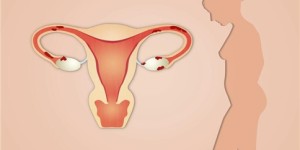 子宫肌瘤会自己消失吗？怀孕后发现子宫肌瘤怎么办？