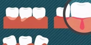 牙龈出血要警惕三种病，牙龈出血是什么原因呢