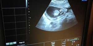三维彩超数据如何看男女？可以通过孕囊大小判断！