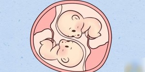 双胞胎输血综合征是什么意思