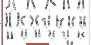 21号染色体三体怎么检查，有什么注意事项？