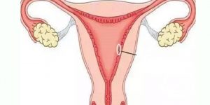 女性子宫腺肌病子宫切除术后还可以怀孕生子吗？