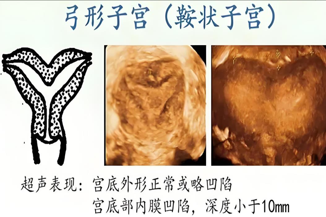 弓形子宫
