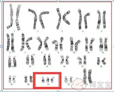 21号染色体三体怎么检查，有什么注意事项？